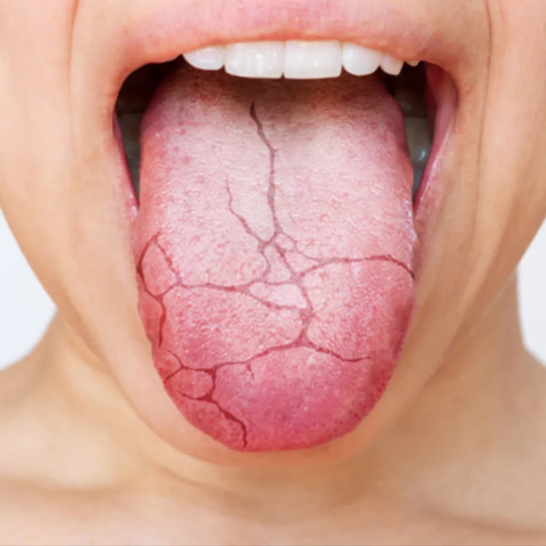 Primer plano de una lengua reseca y agrietada, una señal frecuente de la boca seca