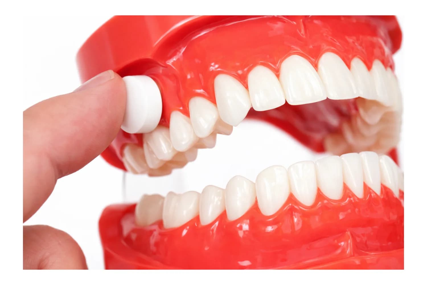 Colocación de una pastilla XyliMelts sobre la encía, mostrada en un modelo dental